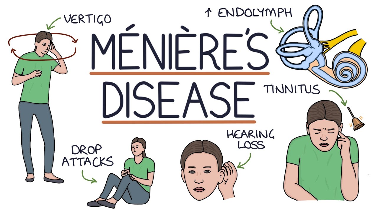 Wat is de Ziekte van Ménière? Complete Uitleg, Symptomen en Behandeling 1 wat is de ziekte van meniere